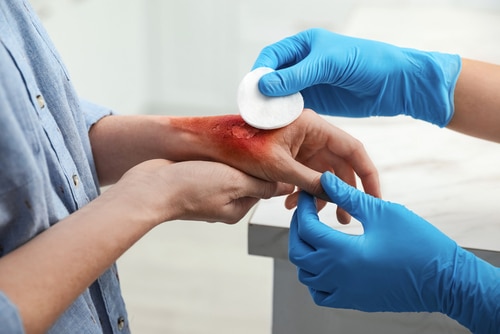 Doctor covering patients burn of hand with cotton pad indoors Doctor covering patients burn of hand with cotton pad indoors